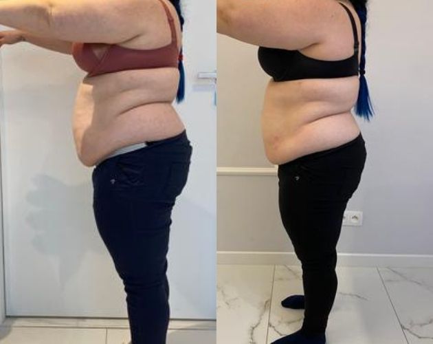 Przed i po liposukcja warszawa