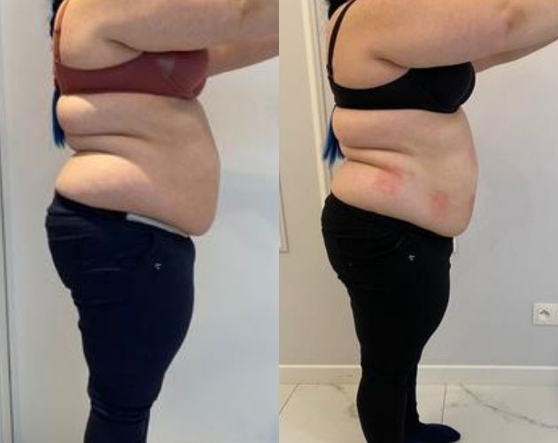 Przed i po liposukcja warszawa
