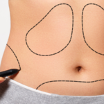 Процедура лазерной липосакции - Tight Sculpting