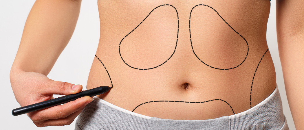 Laser liposuction treatment - Tight Sculpting