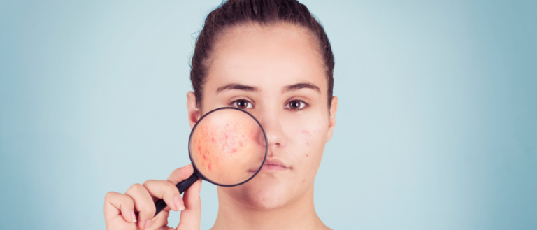 Laser treatment for active acne at Wellclinic
