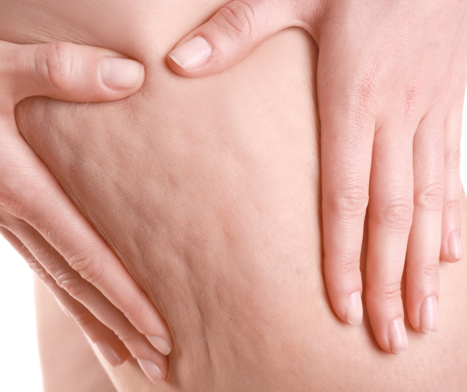 Wasser Cellulite