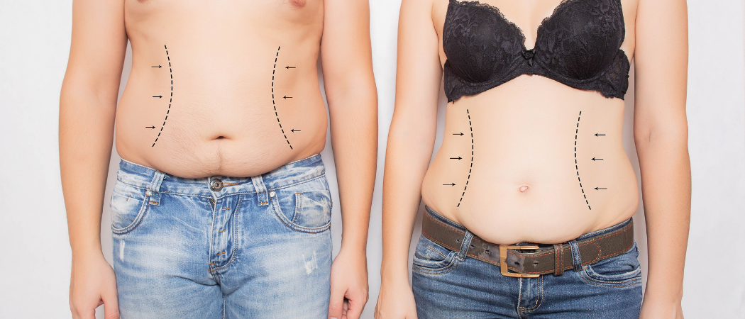 Laser-Lipolyse-Behandlung in der Wellclinic