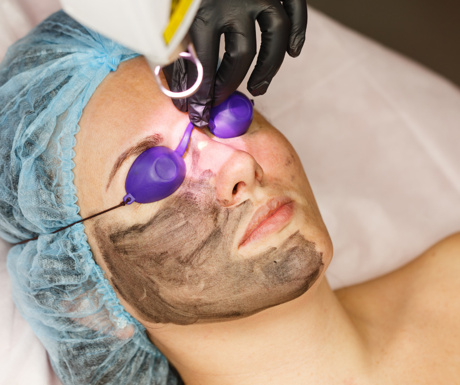 Peeling laserowy