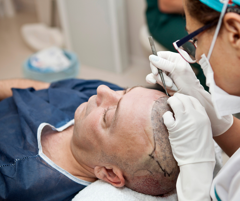 Hair transplantation