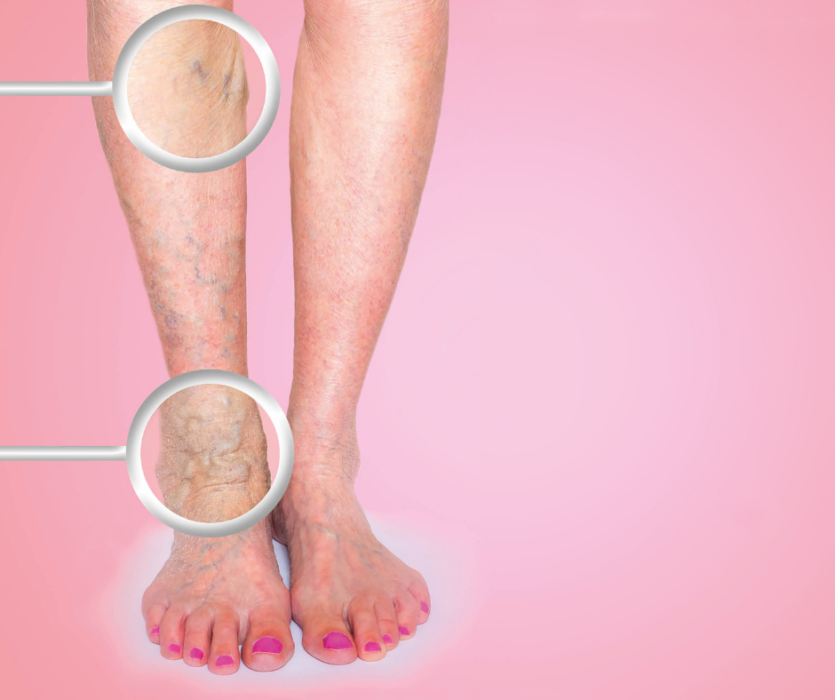 Varicose veins