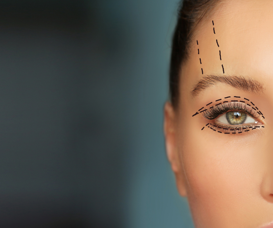 Blepharoplasty