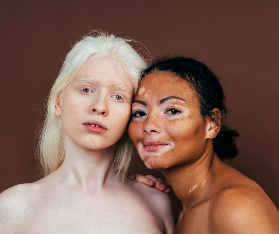 Vitiligo