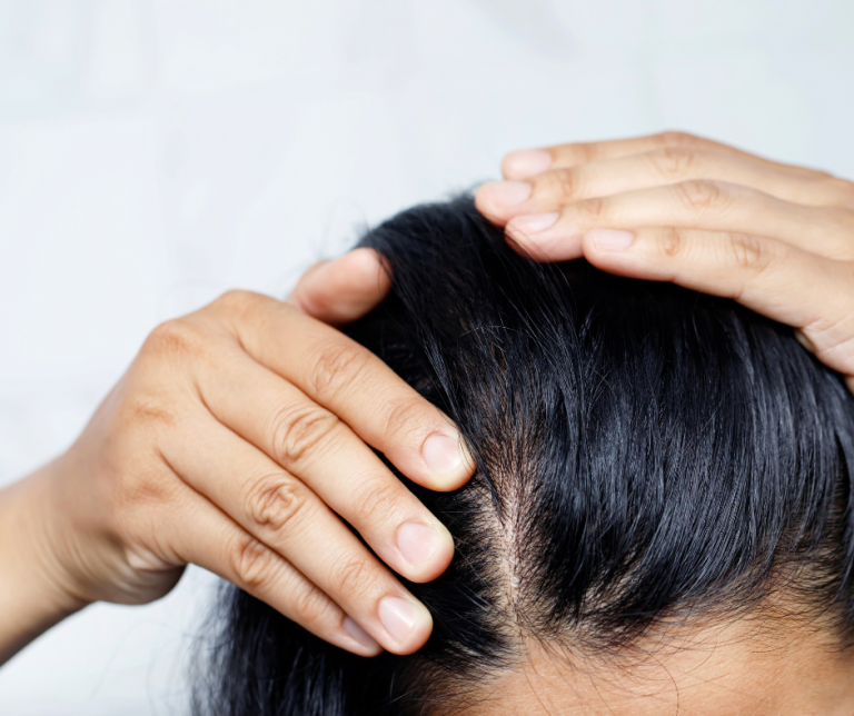 telephone alopecia