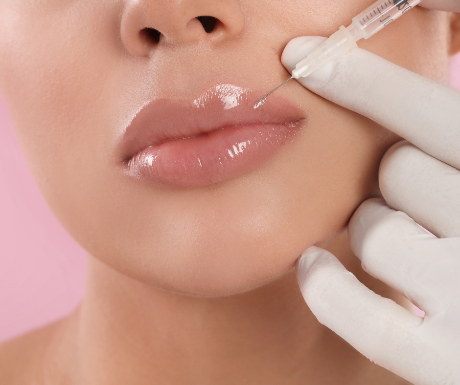 Lip augmentation
