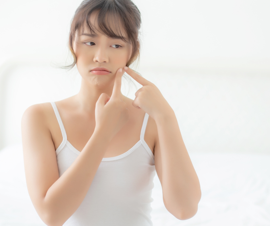 Acne scarring