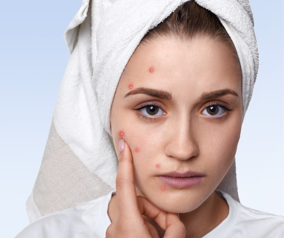 Akne rosacea