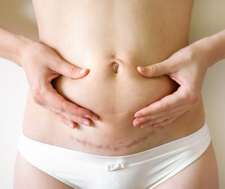 Endometriosis excision scar - how is it removed?