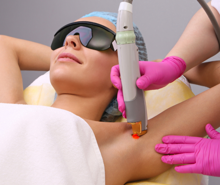 laser depilation