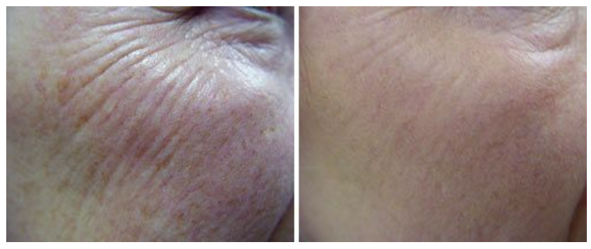 Laser peeling
