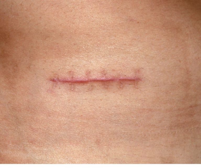 surgical scars