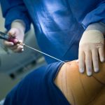 Liposuktion oder schmerzhaft