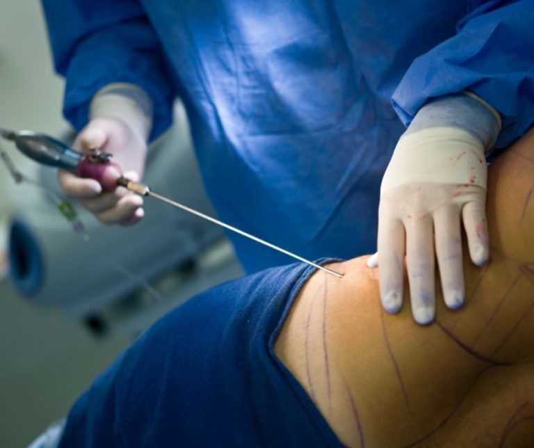 Liposuktion oder schmerzhaft