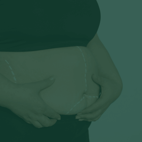 Ile kosztuje liposukcja laserowa?