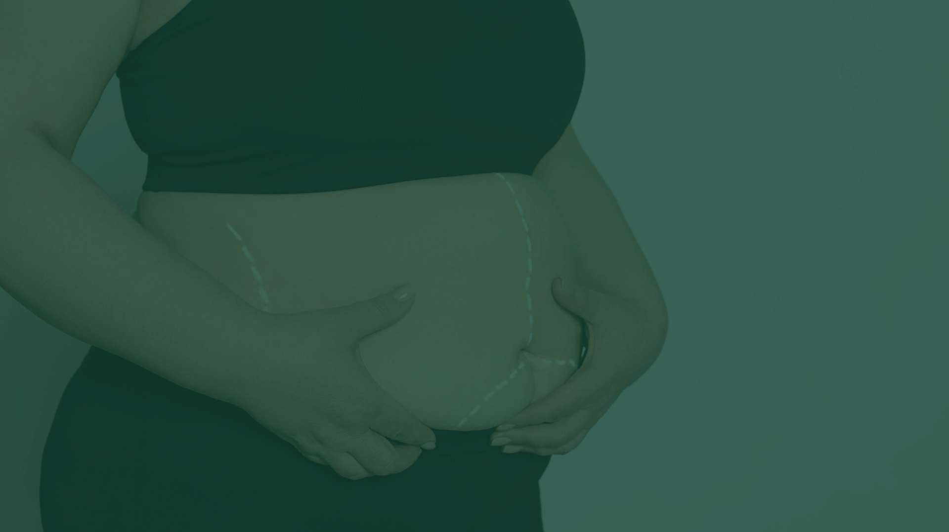 laser liposuction price