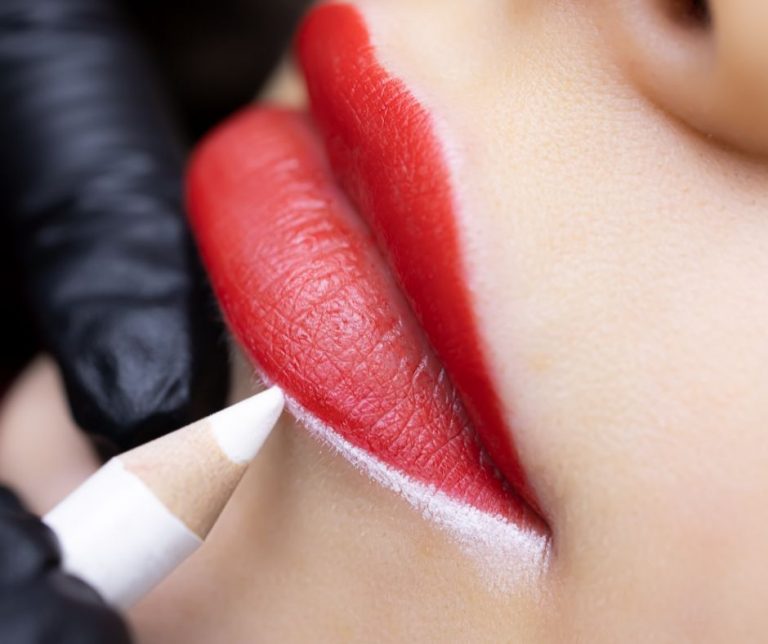 Lip modelling with hyaluronic acid