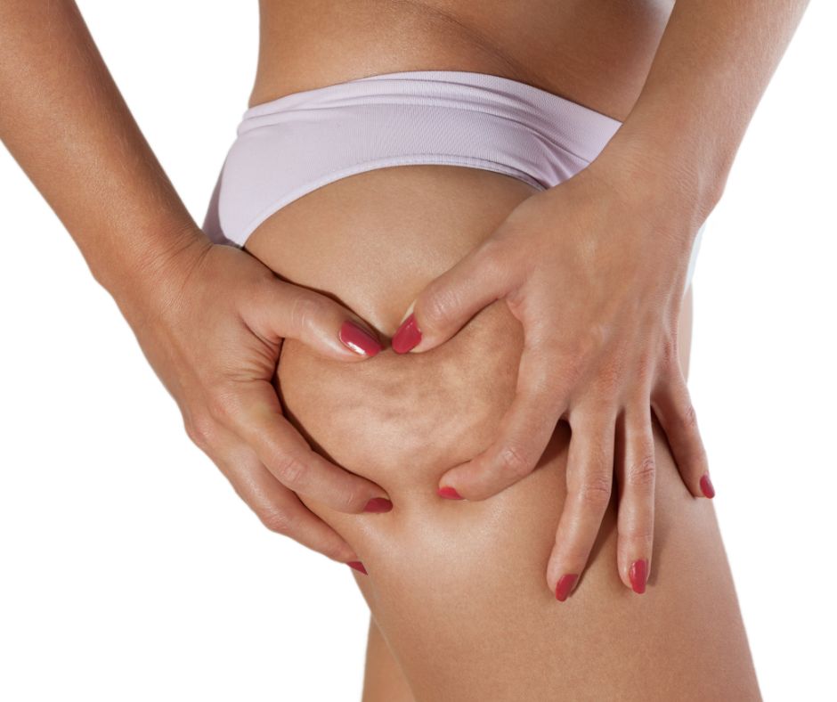 Entfernung von Cellulite