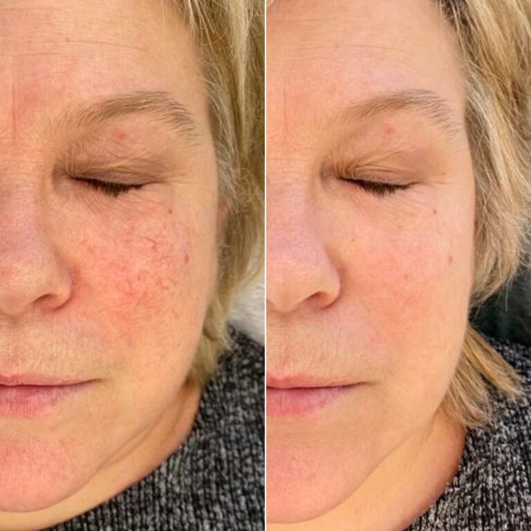 Zamykanie naczynek na twarzy laserem Fotona w Warszawie i Gdańsku