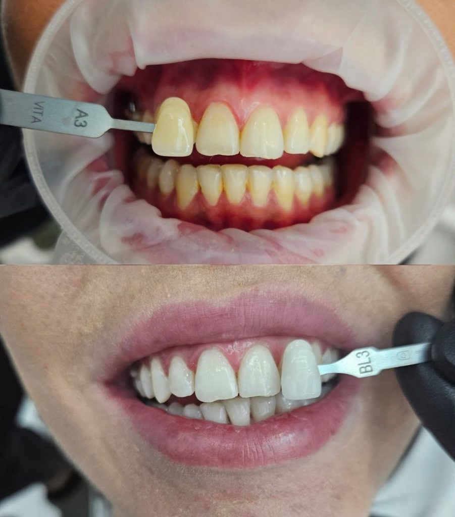 Wybielanie zębów efekty