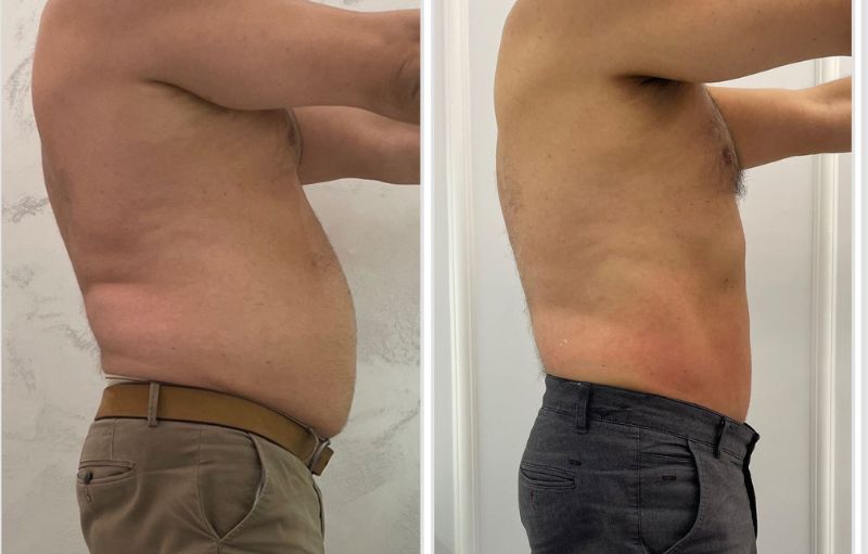Przed i po, odchudzanie meżczyzna, liposukcja laserowa 2