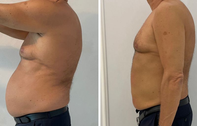 Przed i po, odchudzanie meżczyzna, liposukcja laserowa