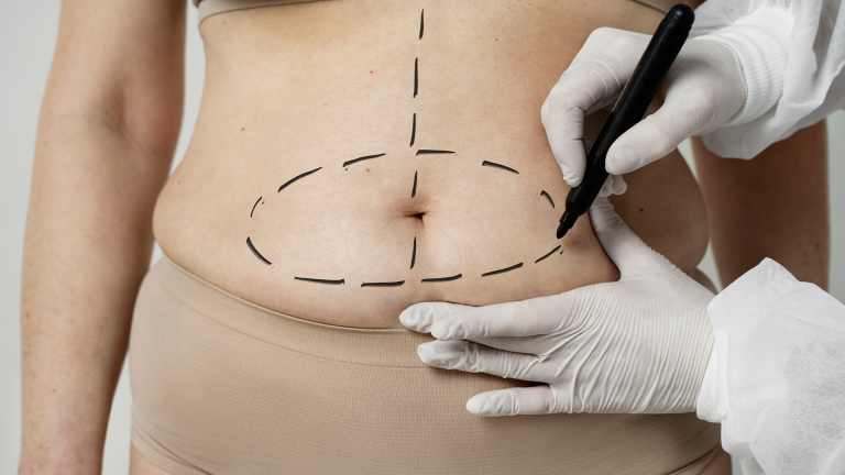 Abdominal liposuction