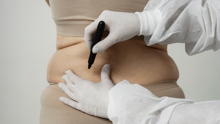 Abdominal liposuction