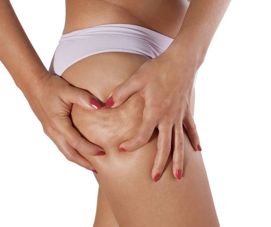 Cellulite on the skin
