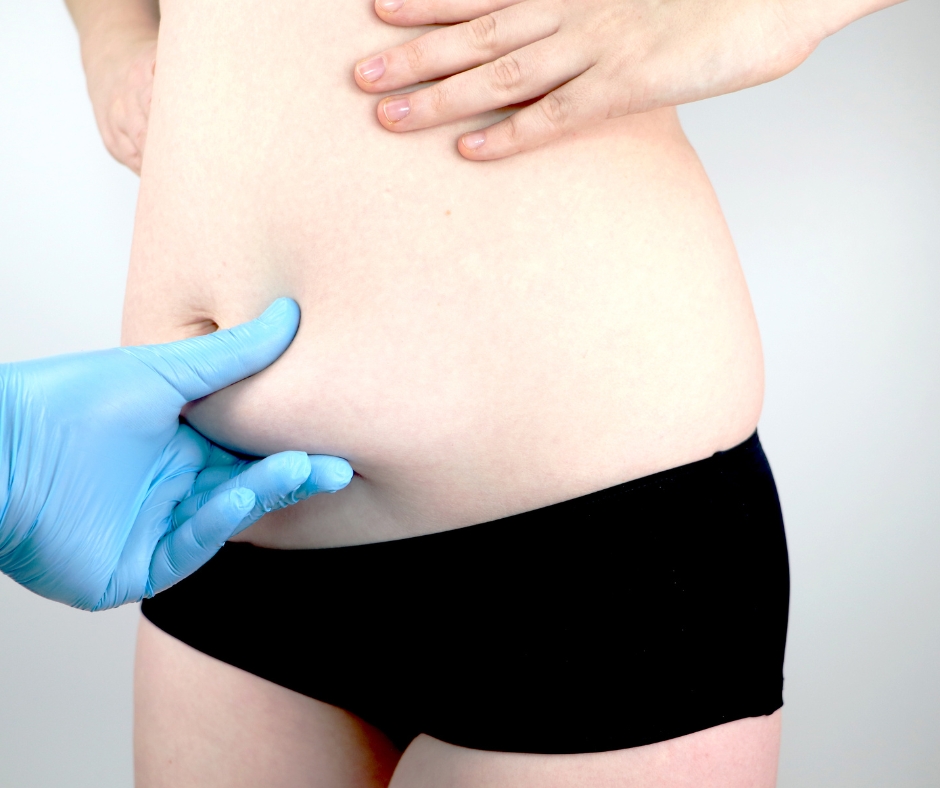 Abdominal plastikk