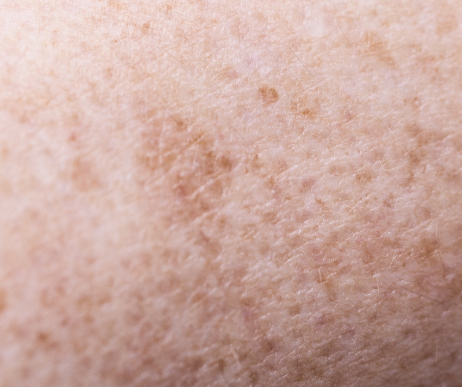 After-sun discolouration