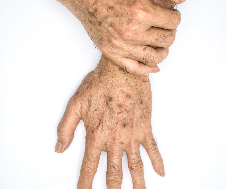 Age spots