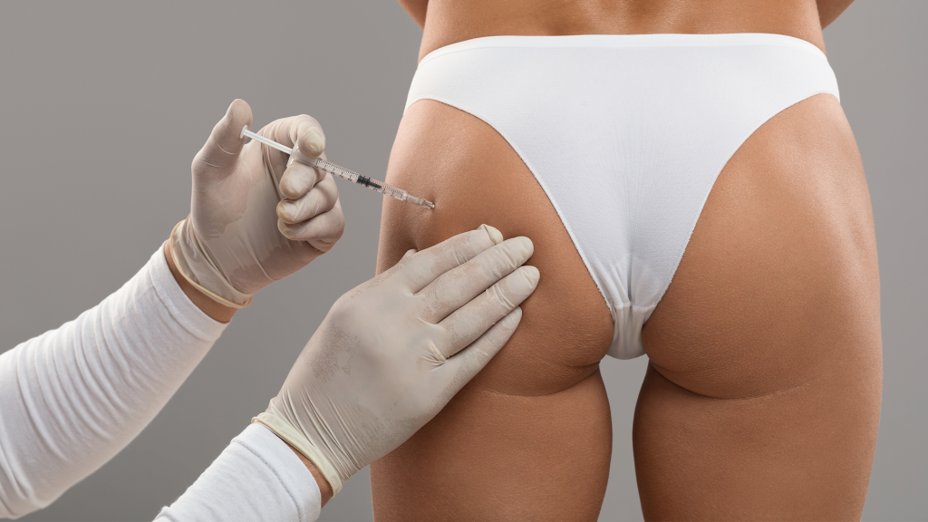 Gluteal augmentation with hyaluronic acid