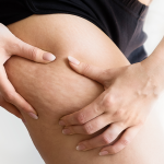 Cellulite-Reduktion