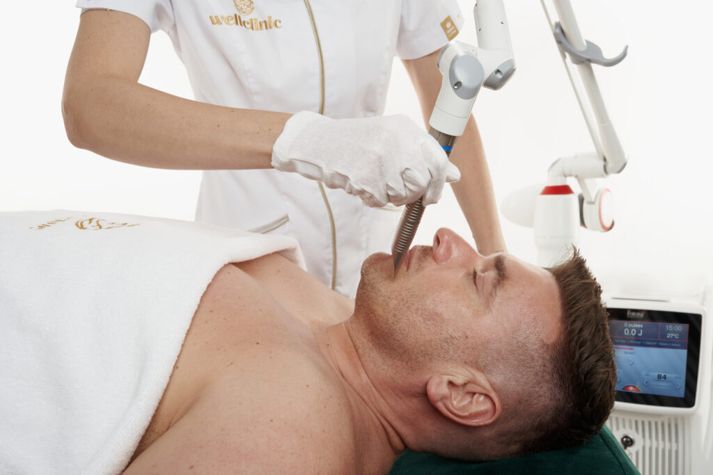 Treatment of facial capillaries