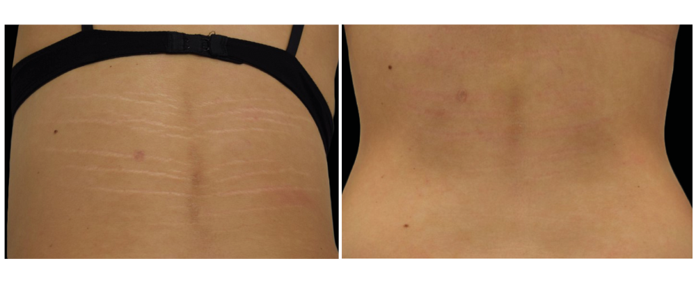 Stretch mark reduction
