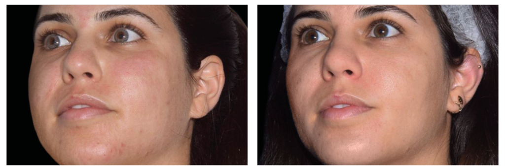Fractional Exion
