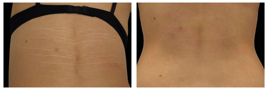 Exion stretch marks