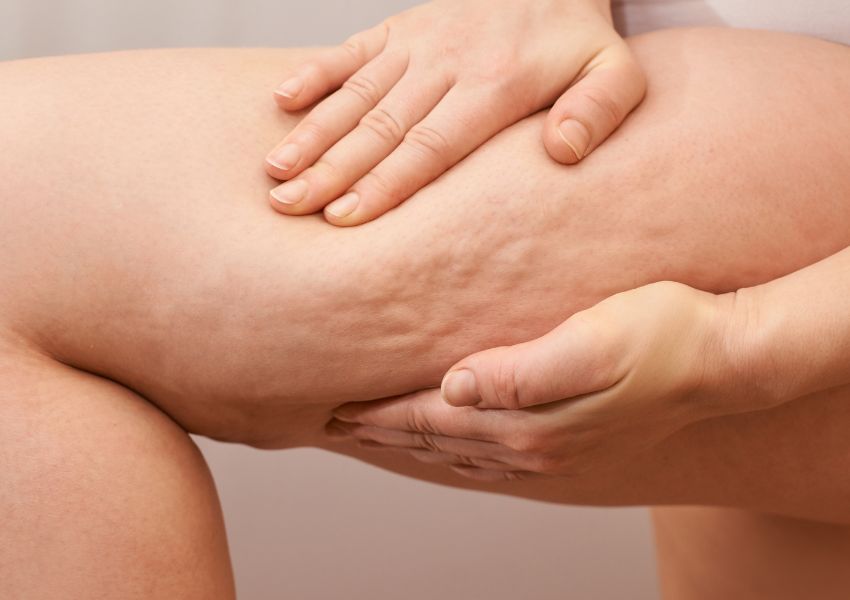 Cellulite – where does it come from?