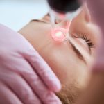 Laser-Gefäßversiegelung in Krakau - die Antwort auf Rötungen und Besenreiser