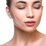 Skalpellfreies Facelifting - was ist das und wie funktioniert es?