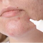 Behandlungen für Akne bei Erwachsenen - welche Methoden bietet die ästhetische Medizin?