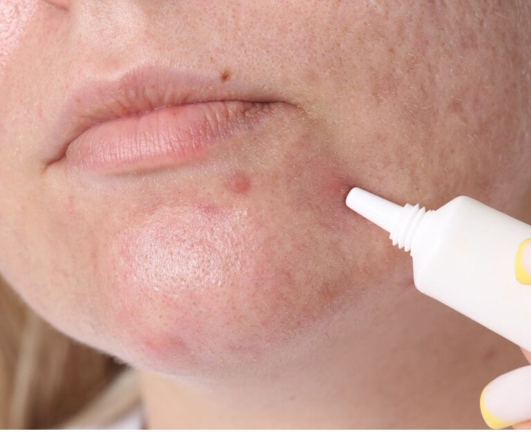 Behandlinger for akne hos voksne - hvilke metoder tilbyr estetisk medisin?