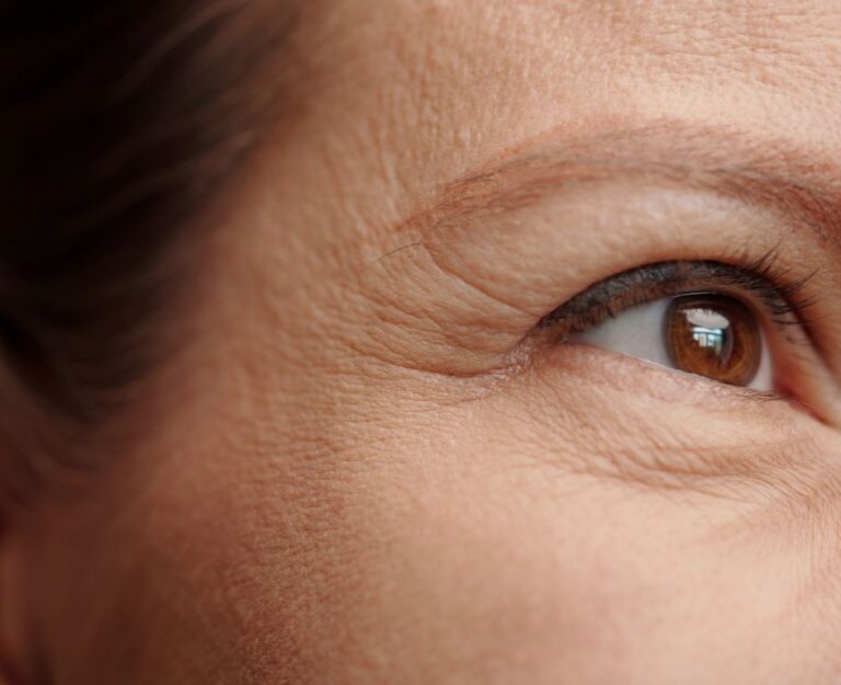 Wrinkles after weight reduction: how to minimise them without fillers?