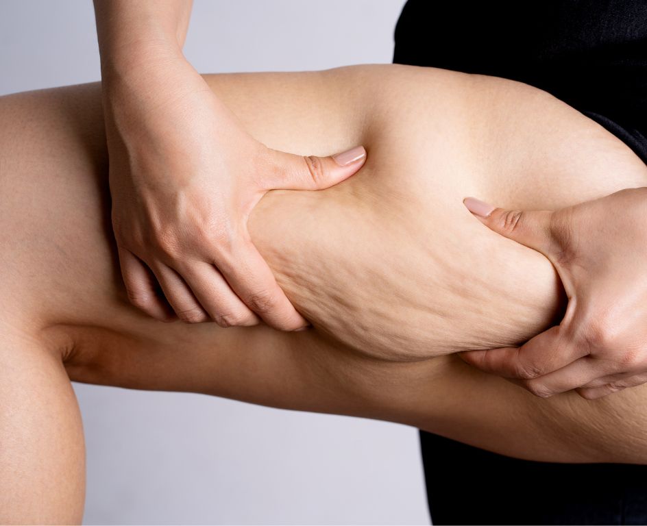 Cellulite