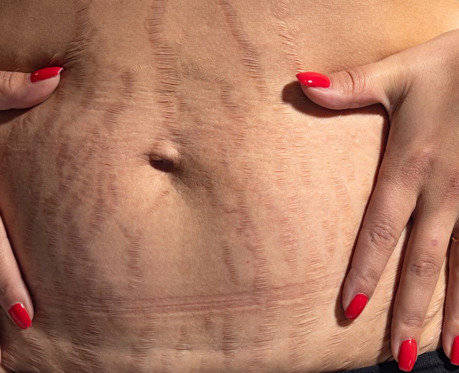 Ciąża i ciało po ciąży – bezpieczne zabiegi odnowy ciała i skóry